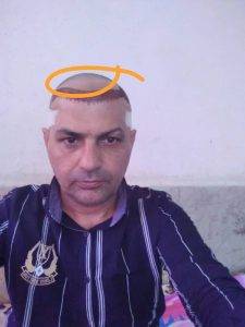 کاشت موی طبیعی.مریم عباسی.شیراز