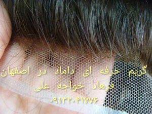پروتز مو